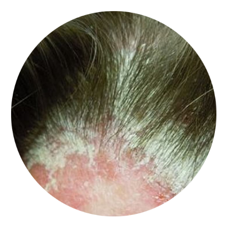 psoriasis con cuero cabelludo
