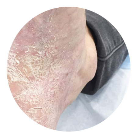 psoriasis con pies