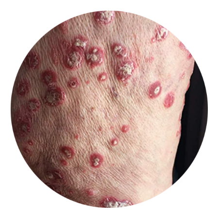 psoriasis con piel