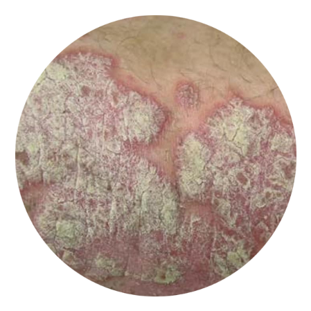 psoriasis con placa